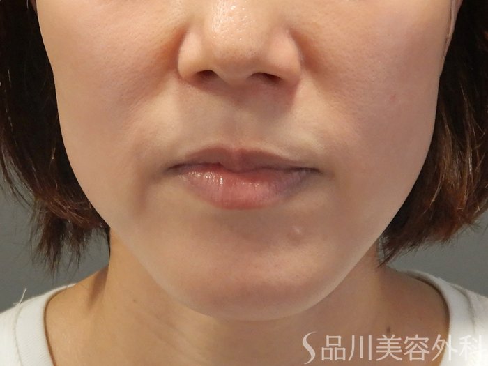 症例NO.71554のBEFORE写真