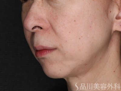 症例NO.72700のAFTER写真