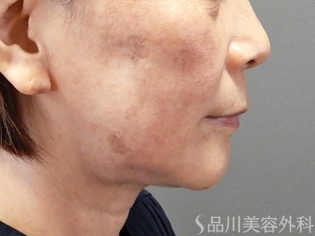 症例NO.70431のAFTER写真