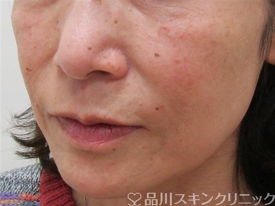 症例NO.30995のAFTER写真
