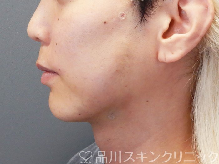 症例NO.74370のAFTER写真