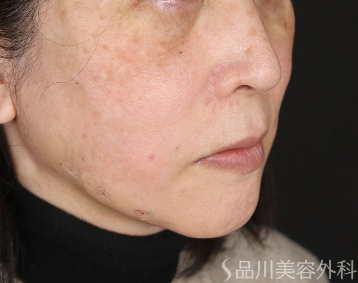 症例NO.72658のAFTER写真