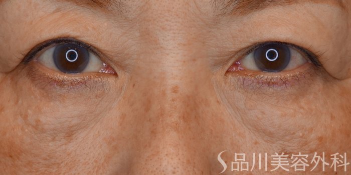 症例NO.72302のBEFORE写真