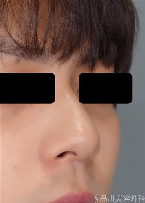 症例NO.51202のBEFORE写真