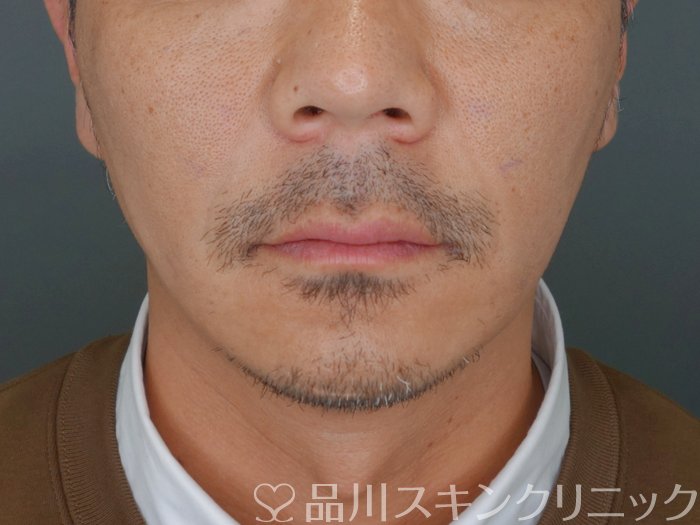 症例NO.72921のAFTER写真