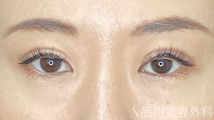 症例NO.74561のAFTER写真