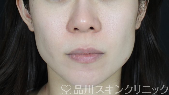 症例NO.71676のBEFORE写真
