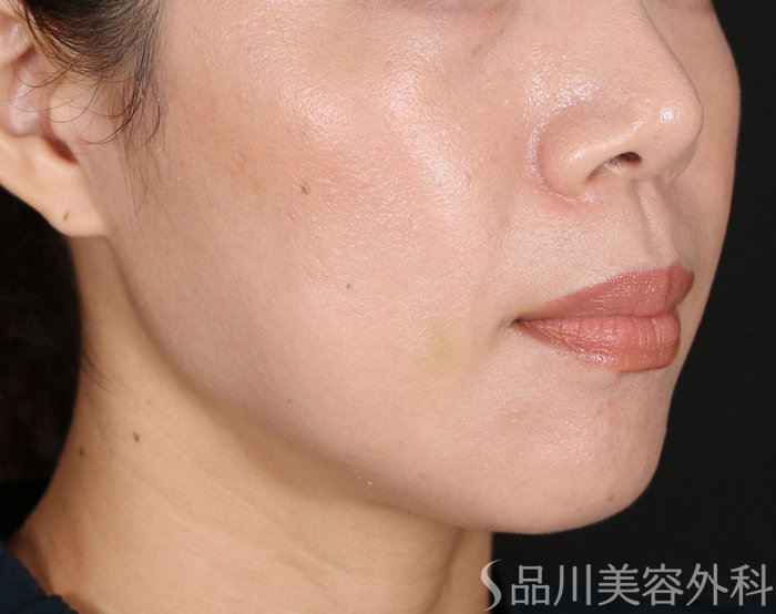 症例NO.71280のAFTER写真