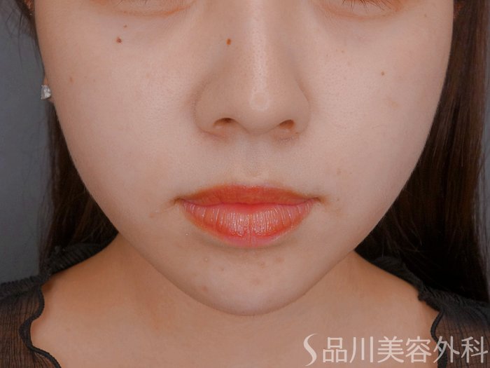 症例NO.73772のAFTER写真