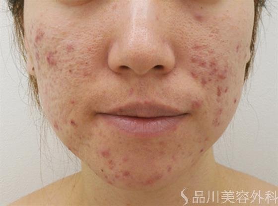 症例NO.26638のBEFORE写真