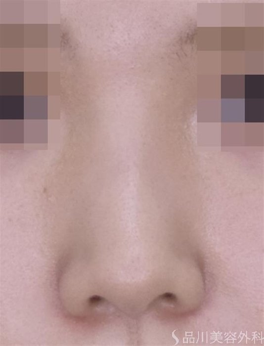 症例NO.50981のBEFORE写真