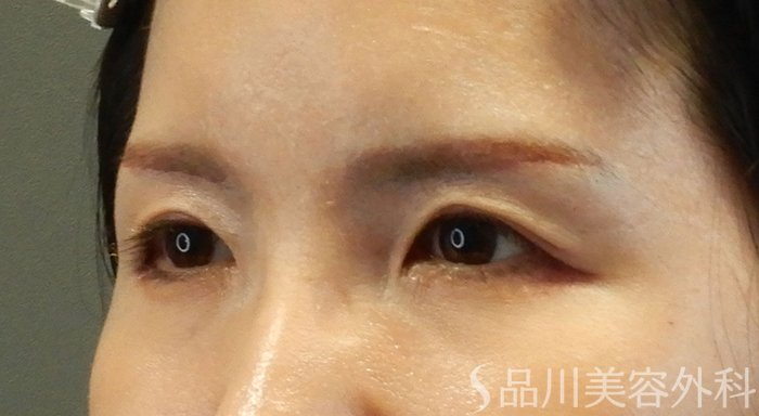 症例NO.65340のAFTER写真