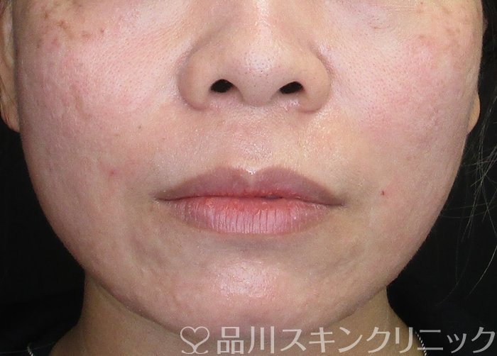 症例NO.75380のAFTER写真