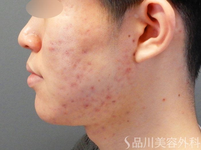 症例NO.64795のBEFORE写真