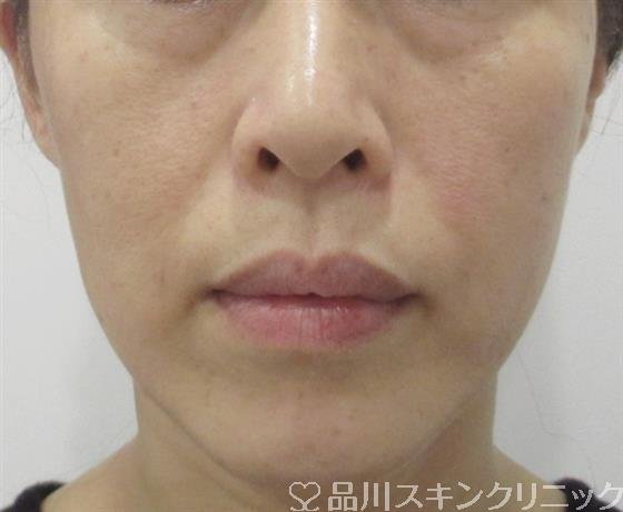 症例NO.31214のAFTER写真