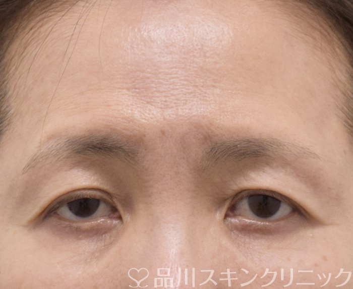 症例NO.71384のBEFORE写真