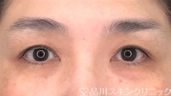 症例NO.60133のBEFORE写真