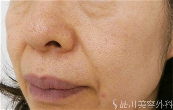 症例NO.20789のBEFORE写真