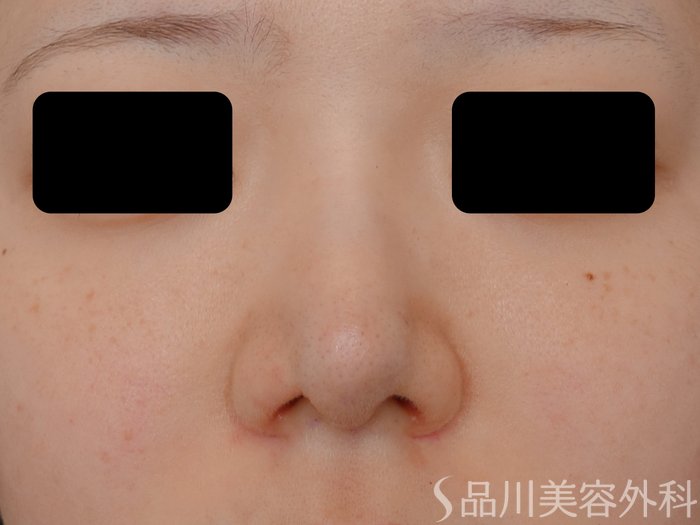 症例NO.71071のAFTER写真
