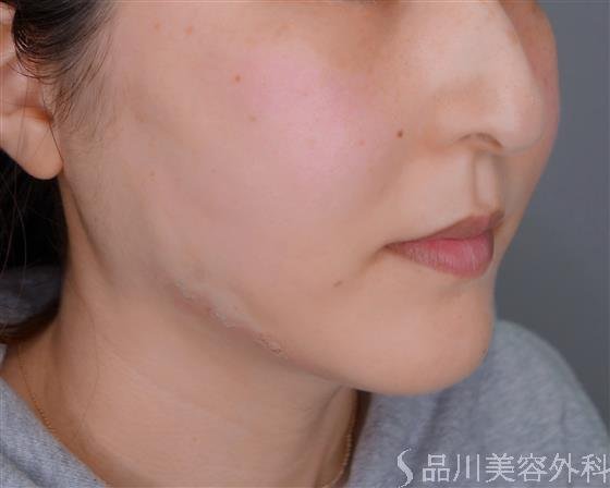 症例NO.54068のAFTER写真