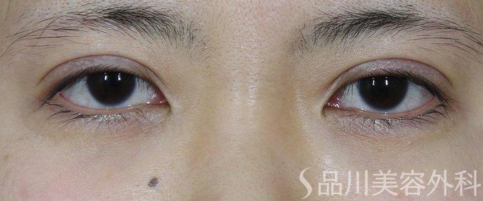 症例NO.72087のAFTER写真