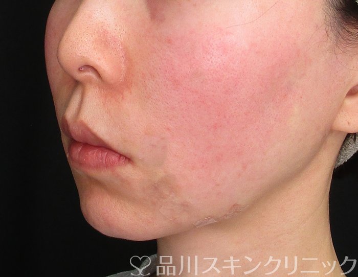 症例NO.73701のAFTER写真