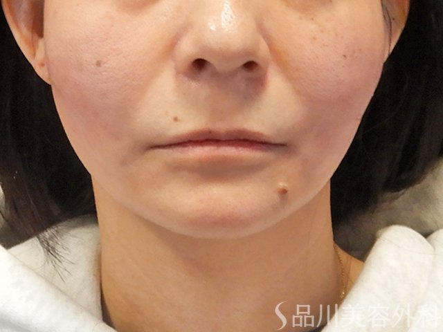 症例NO.73685のAFTER写真