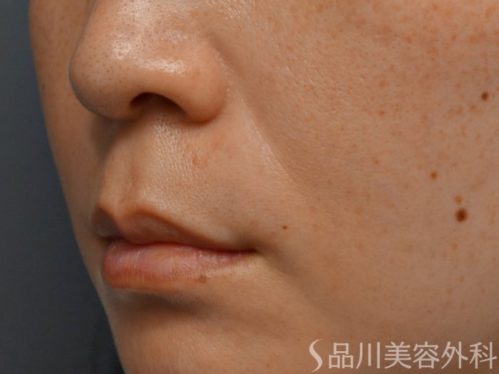 症例NO.71948のBEFORE写真