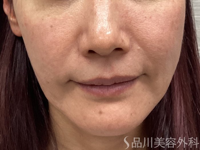 症例NO.62313のBEFORE写真