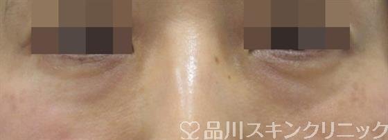 症例NO.33435のBEFORE写真