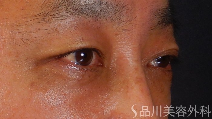 症例NO.68996のBEFORE写真