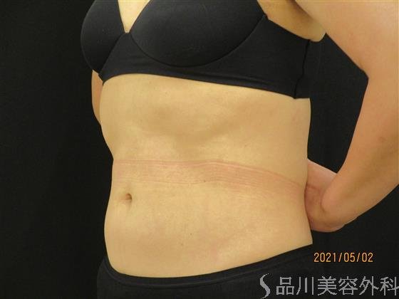 症例NO.52094のAFTER写真
