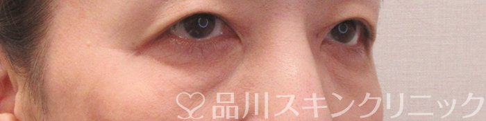 症例NO.70229のBEFORE写真