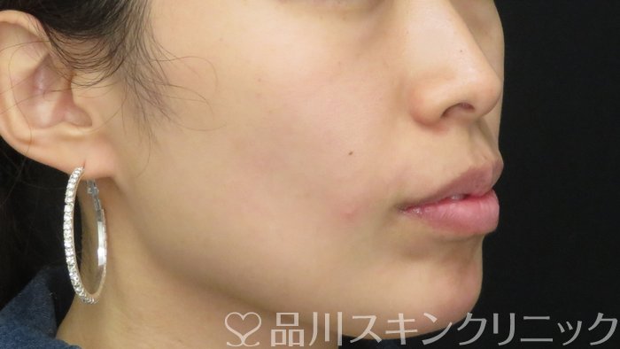 症例NO.71378のAFTER写真