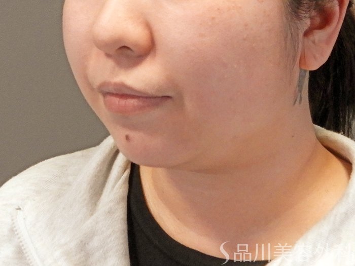 症例NO.64193のBEFORE写真