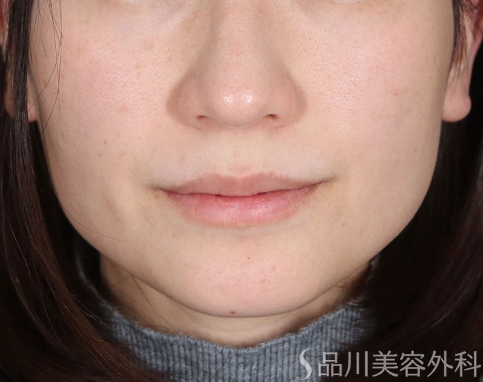 症例NO.73669のBEFORE写真