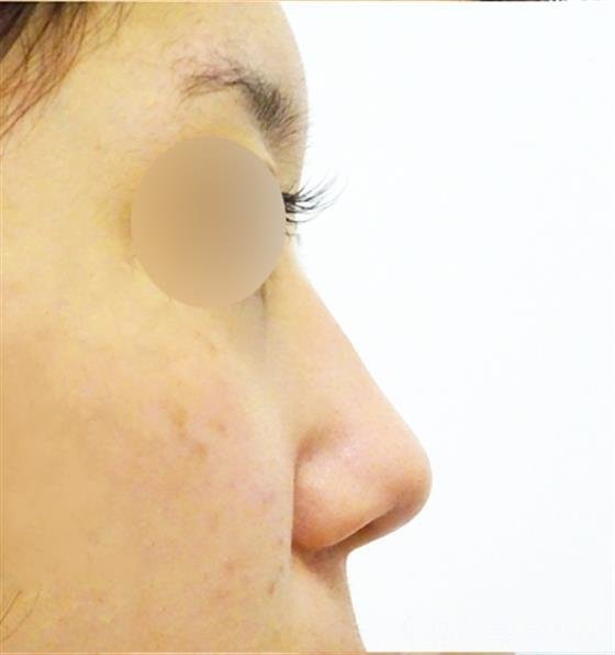 症例NO.49640のBEFORE写真