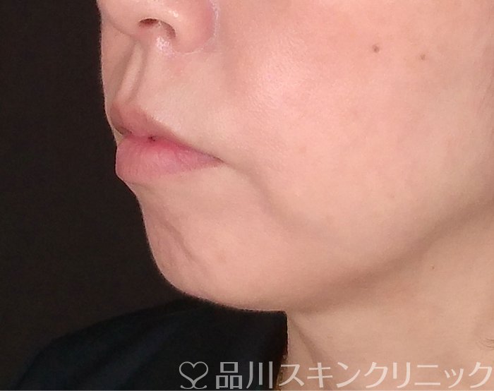 症例NO.70079のBEFORE写真