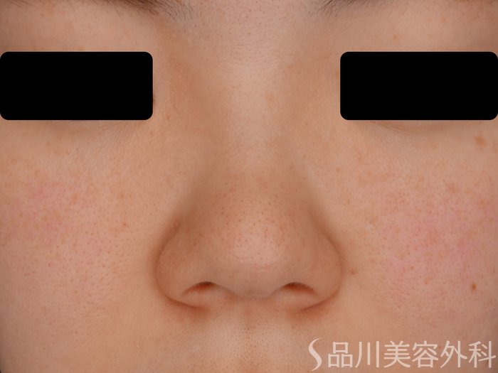 症例NO.62493のBEFORE写真