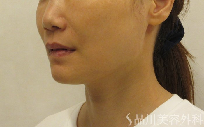 症例NO.72341のBEFORE写真