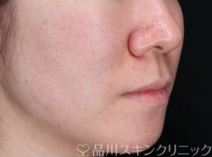 症例NO.63999のAFTER写真