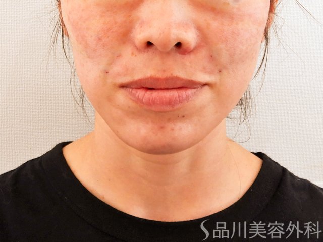 症例NO.62452のAFTER写真