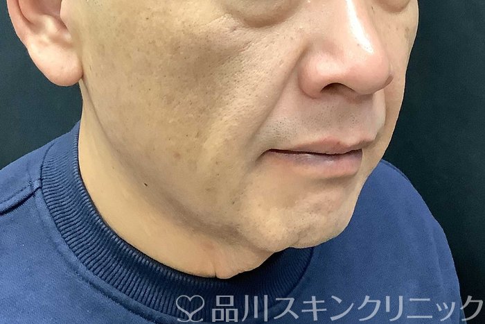 症例NO.69615のBEFORE写真