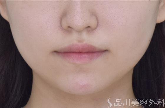 症例NO.50066のAFTER写真