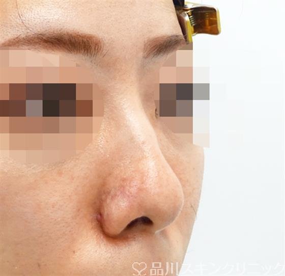 症例NO.48793のBEFORE写真