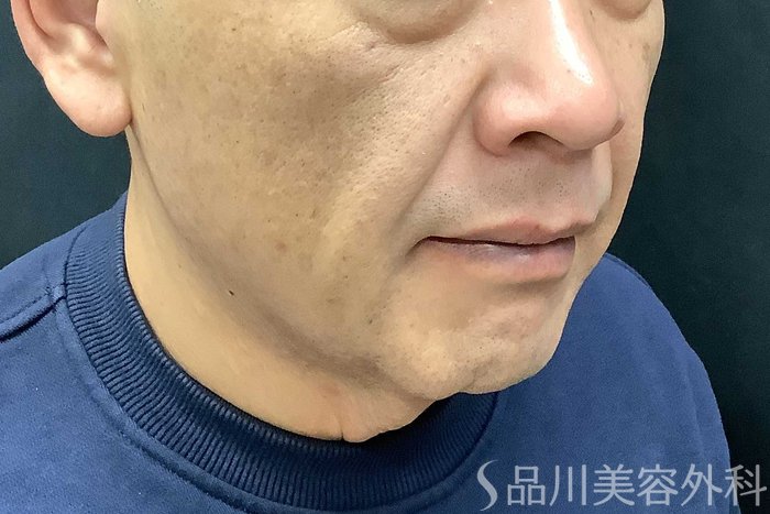 症例NO.69615のBEFORE写真