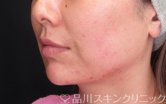 症例NO.74862のAFTER写真