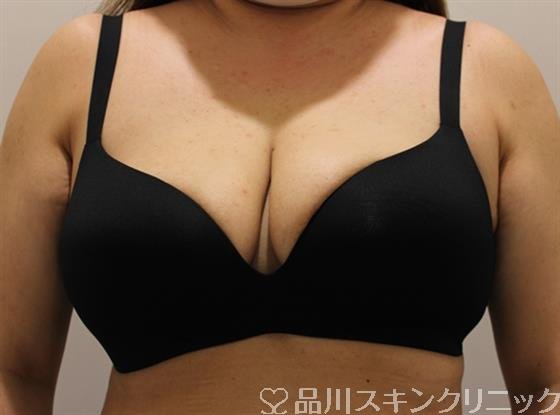 症例NO.51583のAFTER写真