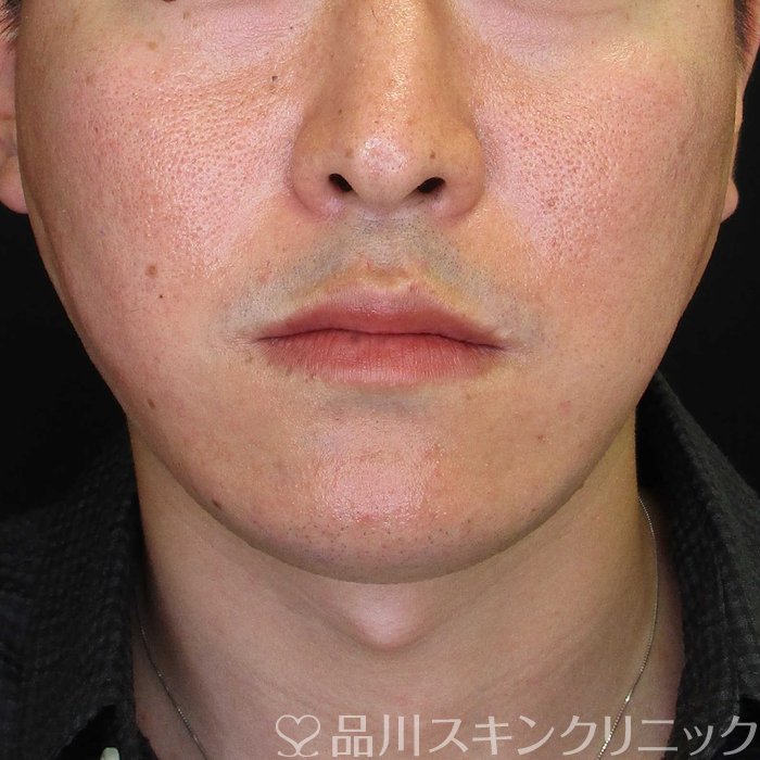 症例NO.67739のAFTER写真