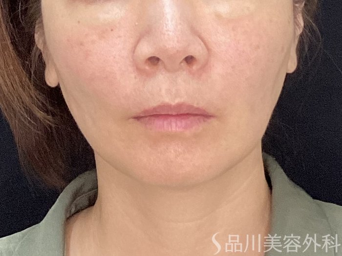 症例NO.71886のAFTER写真